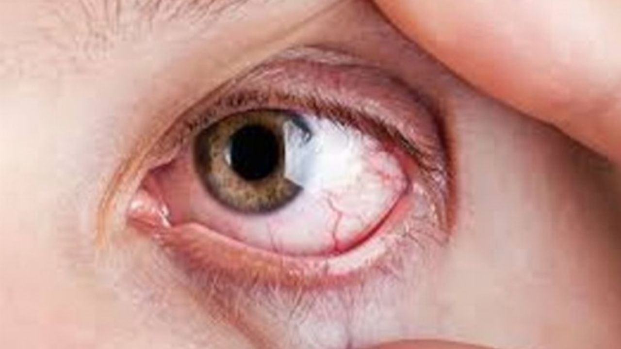 Dikkat! Bu hastalık 80 milyon kişide görülüyor!