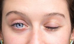 Yüz felcinde soğuk hava masum mu?