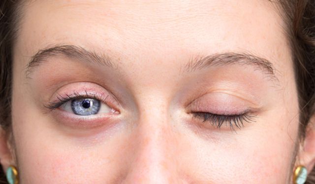 Yüz felcinde soğuk hava masum mu?