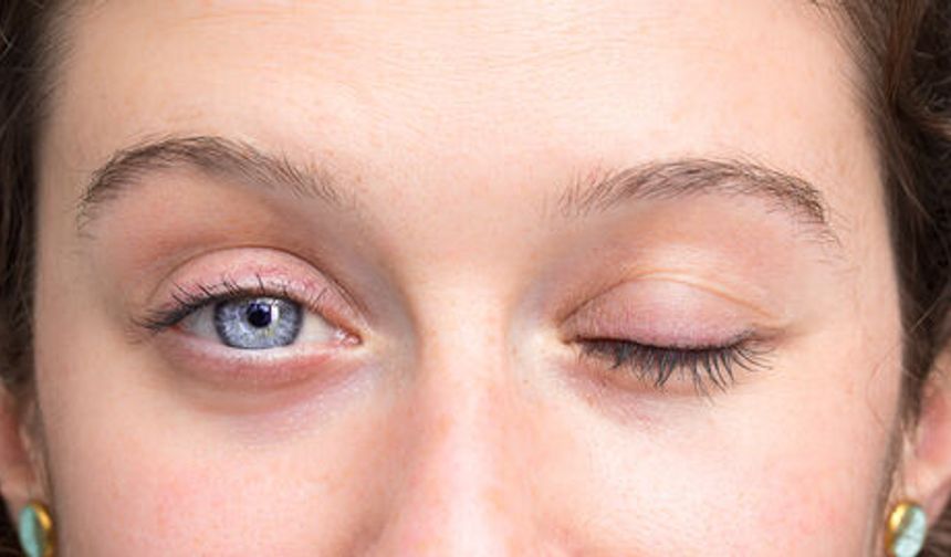 Yüz felcinde soğuk hava masum mu?